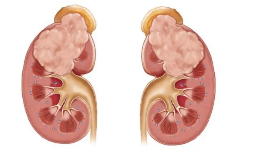 10 Hội Chứng Di Truyền Có Thể Dẫn Đến Ung Thư Thận