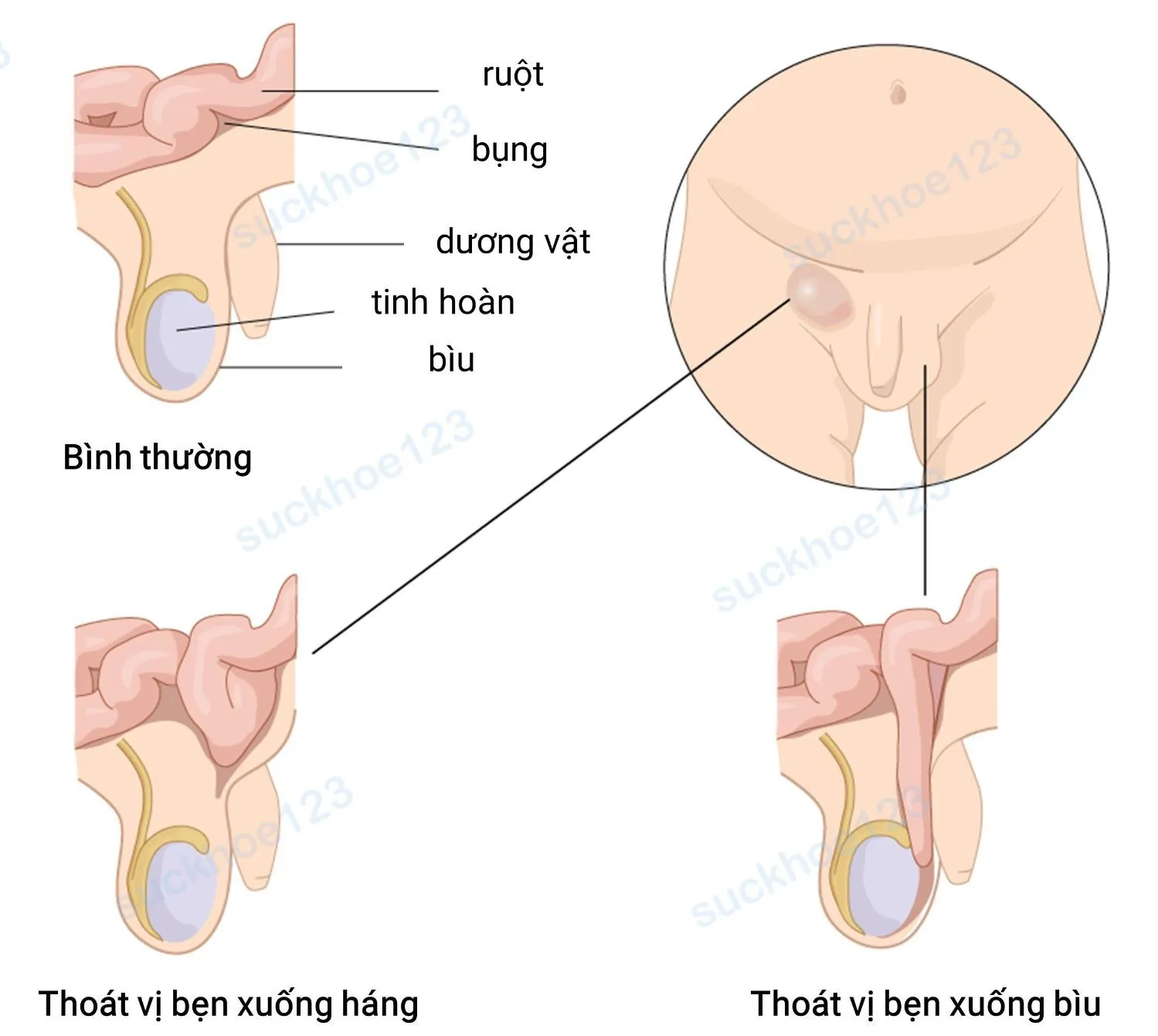 thoát vị bẹn