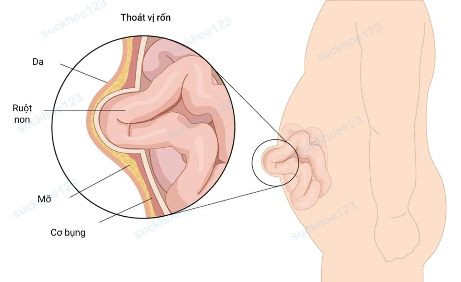 thoát vị rốn