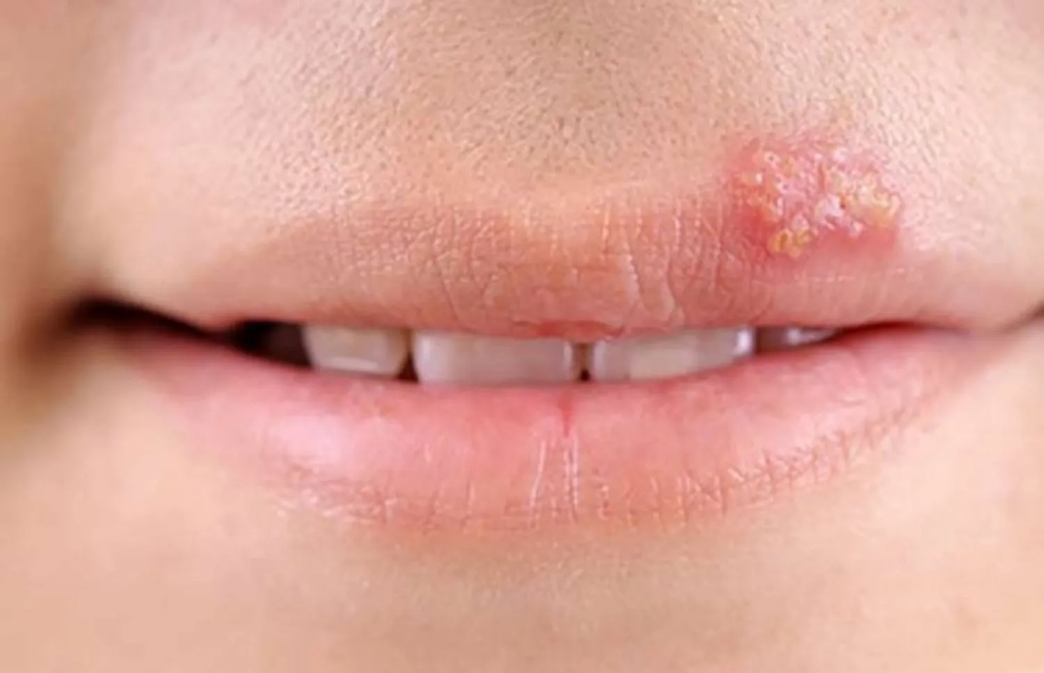 Cách nhận biết bệnh mụn rộp (herpes)