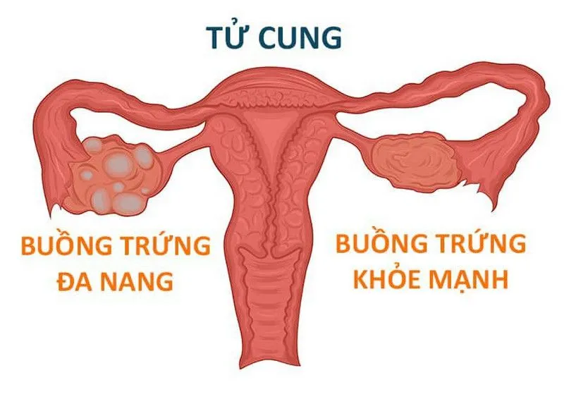 Hội chứng buồng trứng đa nang