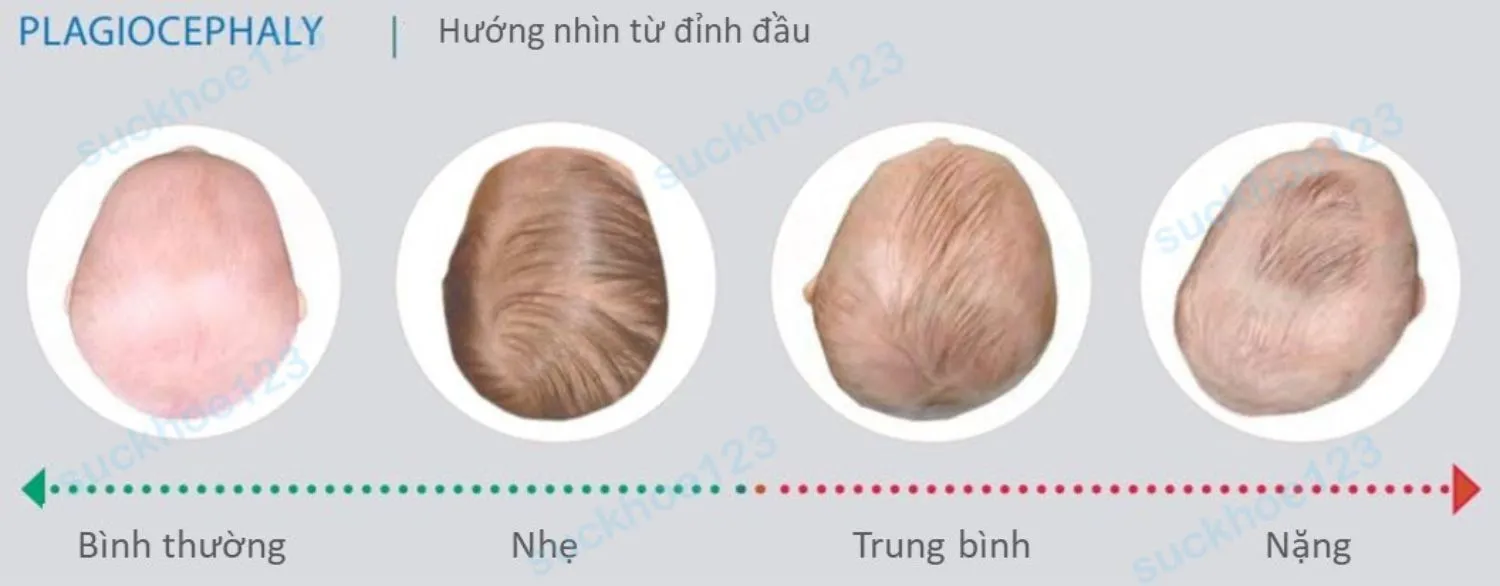 Hội chứng bẹt đầu ở trẻ