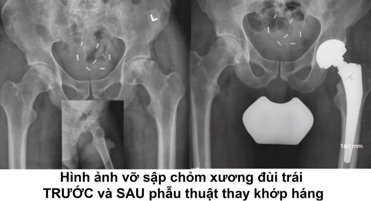 hoai tu chom xuong dui 2