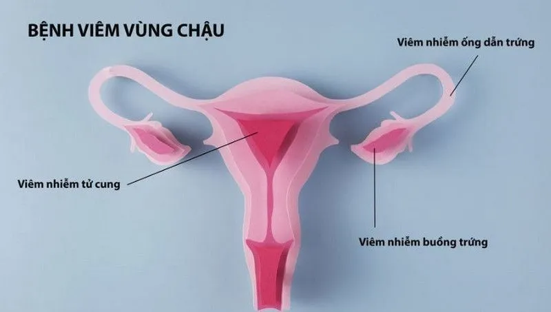 Bệnh viêm vùng chậu