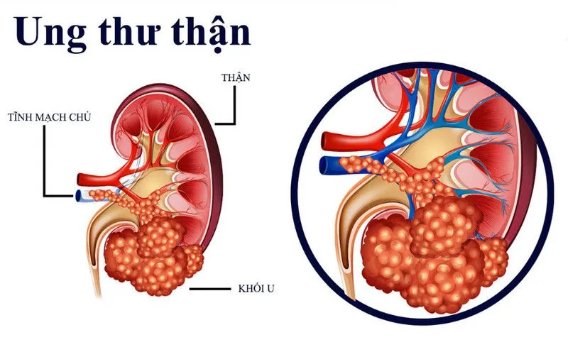 Điều trị ung thư thận bằng phương pháp đốt