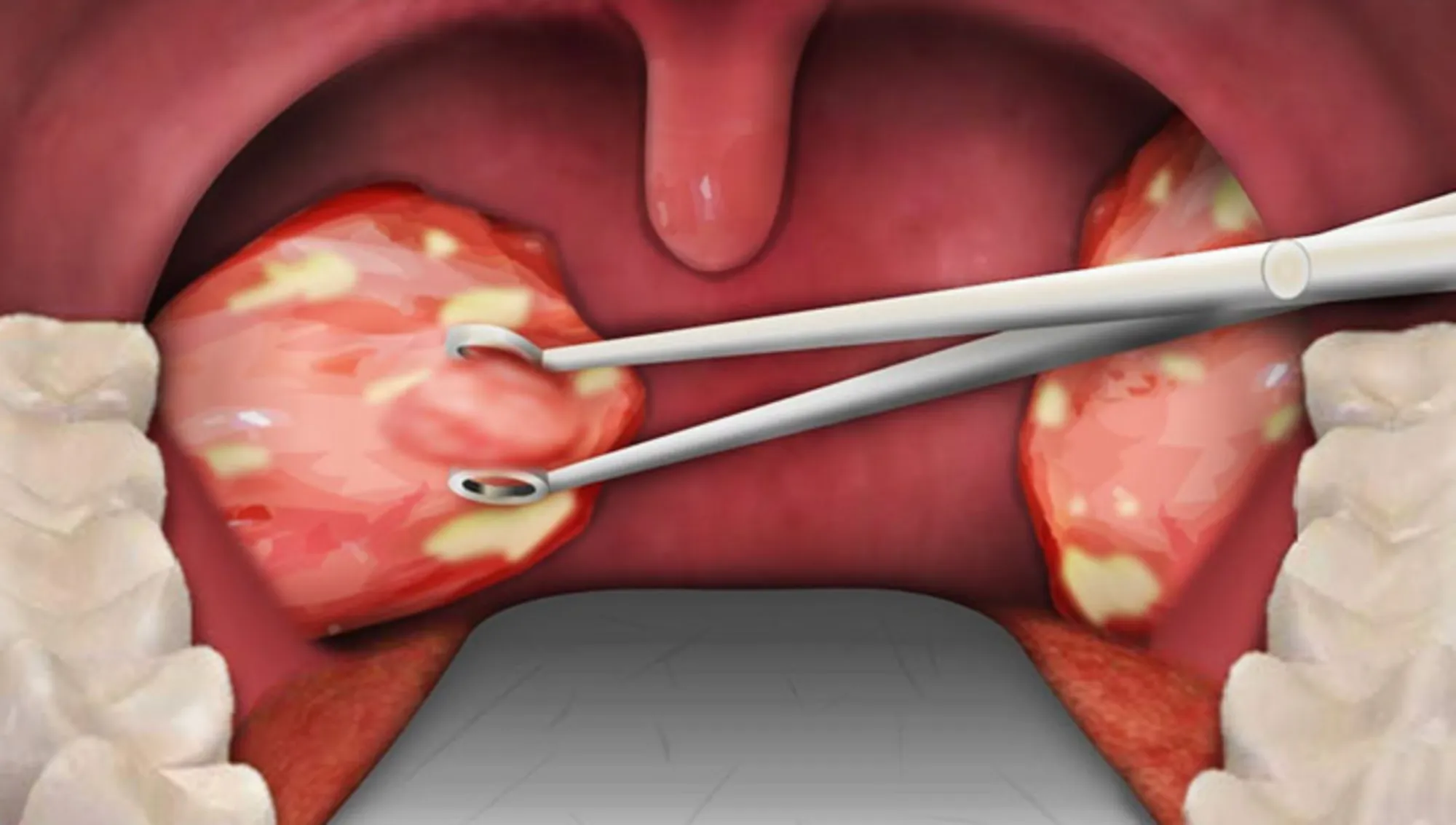 Đốm trắng trong họng là bệnh gì?