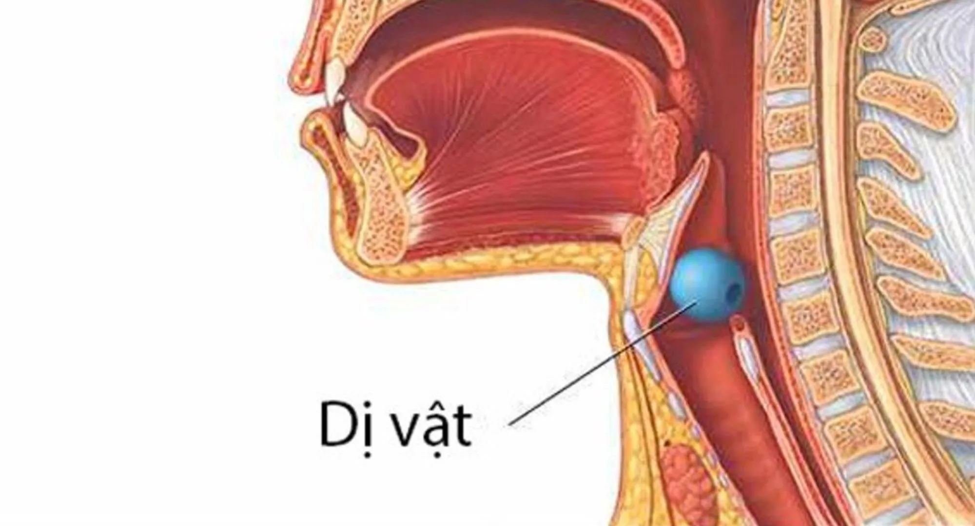 Hậu quả khôn lường do nuốt phải dị vật khi ăn uống