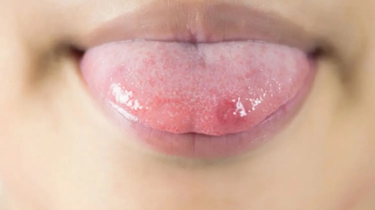 Herpes lưỡi