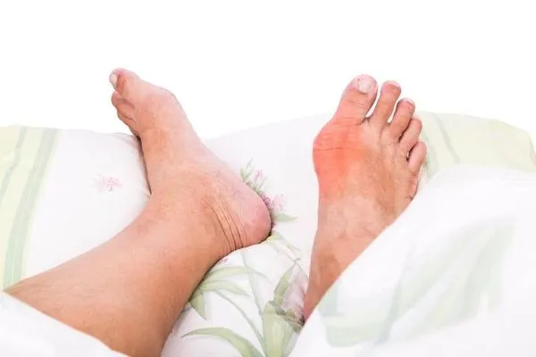 Mối liên hệ giữa bệnh gout và đái tháo đường