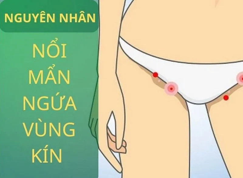 Nguyên nhân mẩn đỏ vùng kín là gì