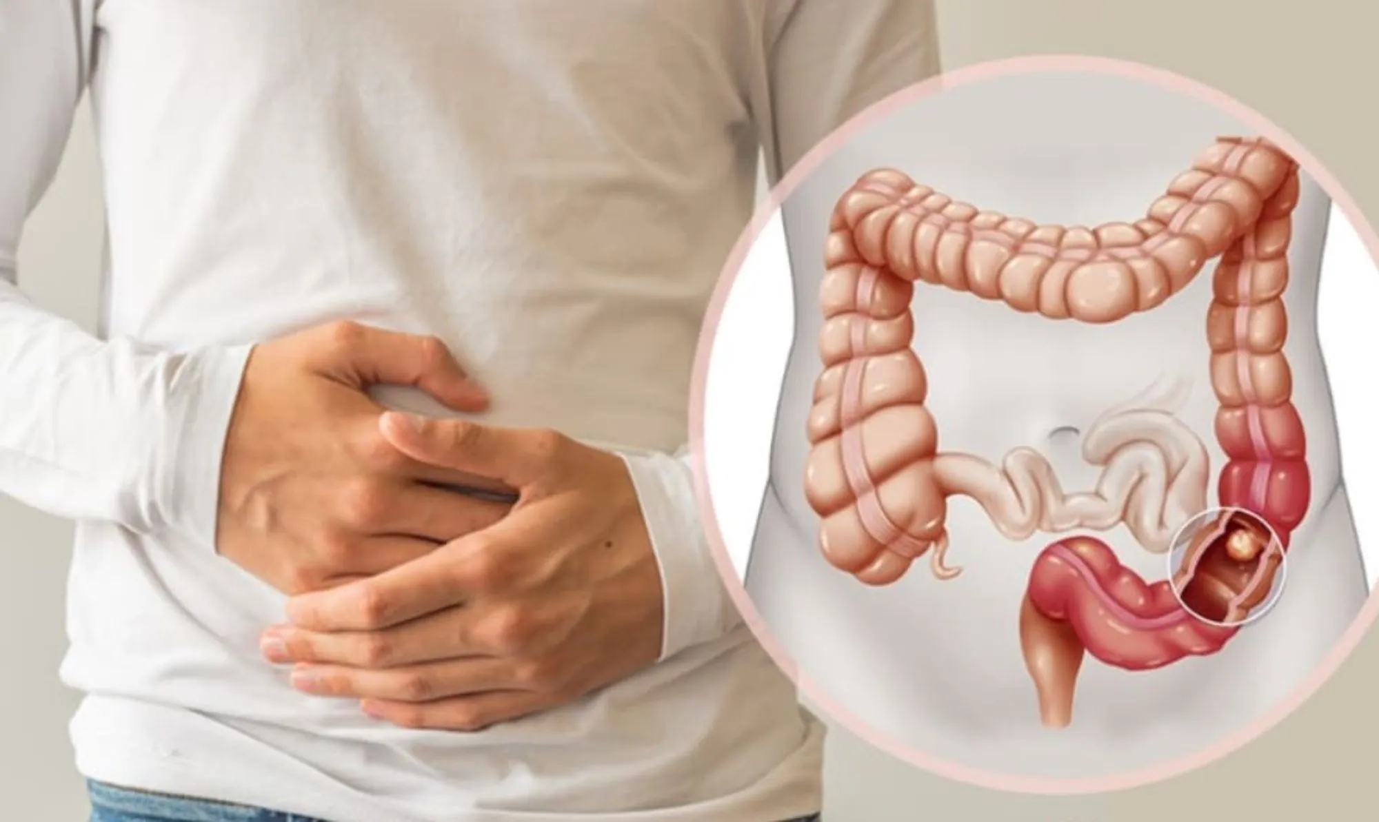 Những yếu tố nguy cơ gây bệnh của Polyp đại tràng