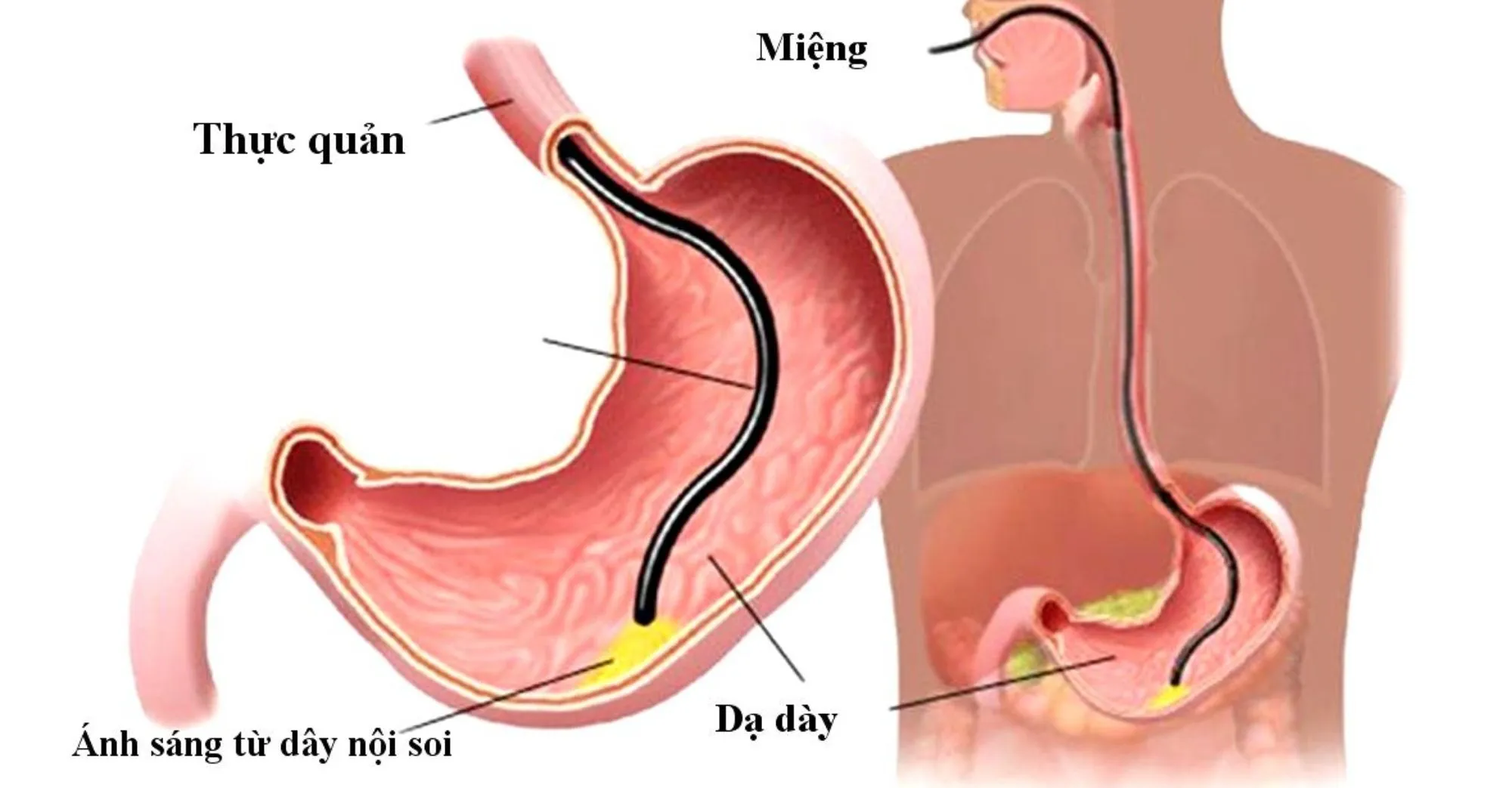 Nội soi dạ dày gây mê có nguy hiểm không?