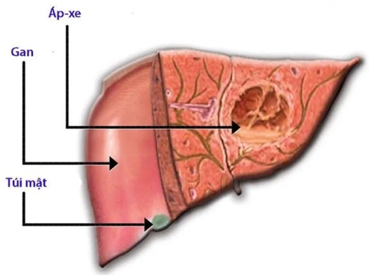 Phát hiện bệnh áp xe gan sau 3 ngày sốt liên tiếp