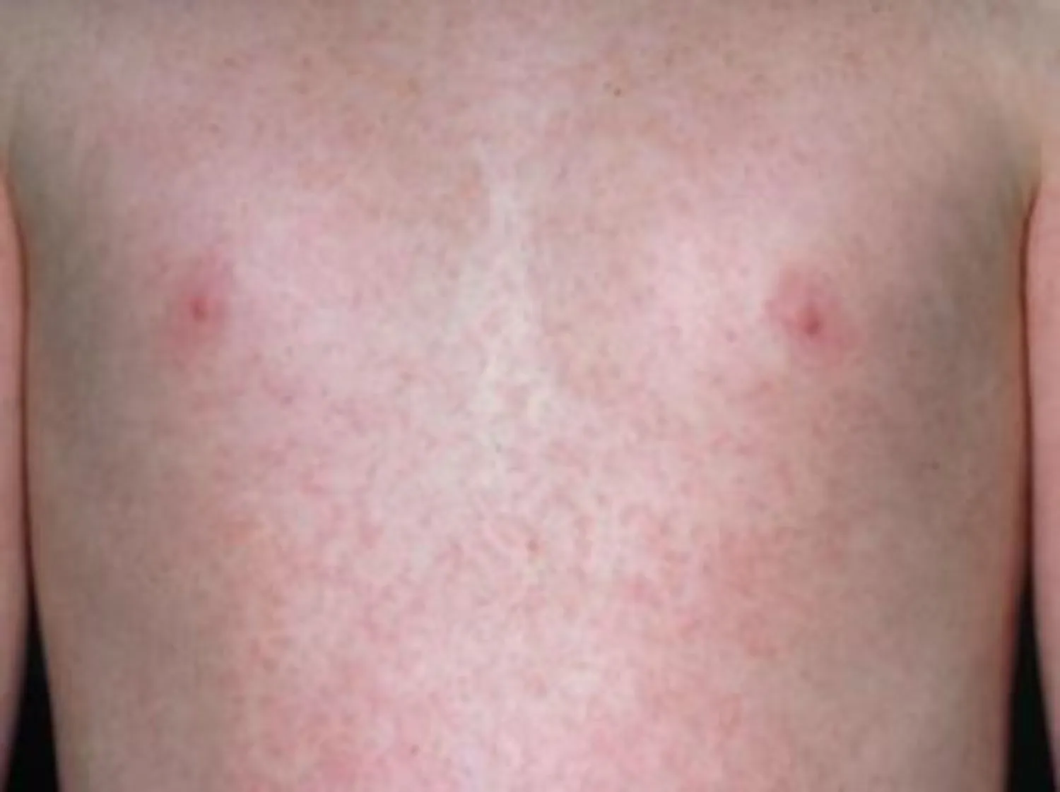 Rubella (bệnh sởi Đức) là bệnh gì?