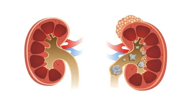 Sỏi niệu quản: Nguyên nhân, triệu chứng, cách điều trị