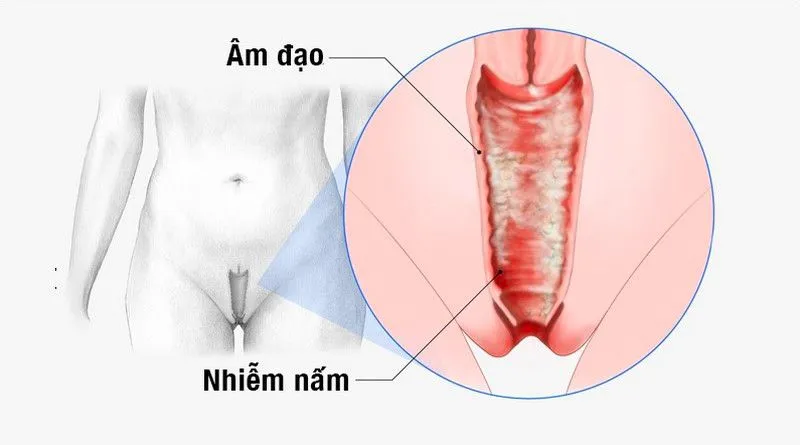 Cách điều trị nấm âm đạo