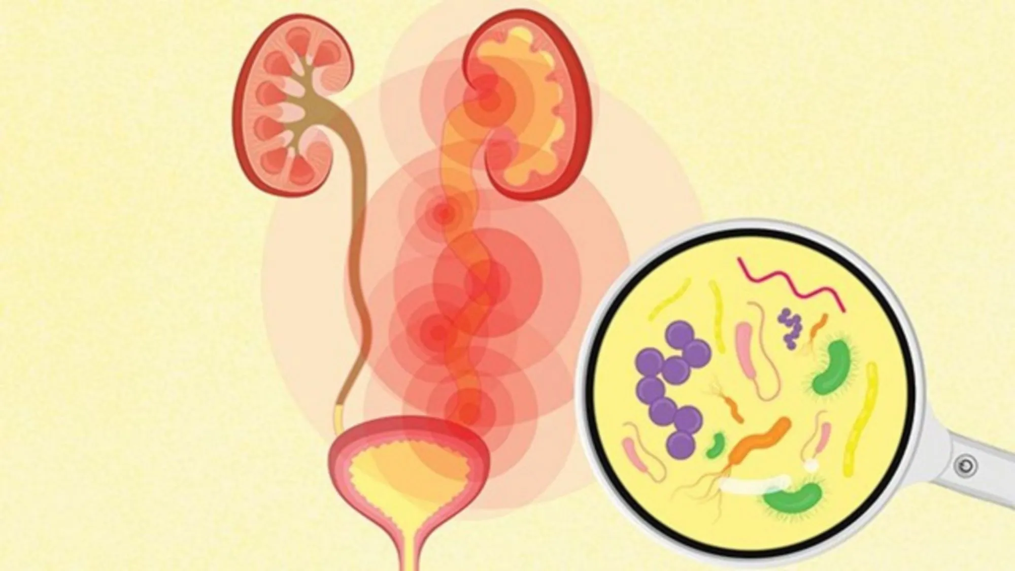 Tại sao nhiễm trùng đường tiết niệu đa phần do vi khuẩn E. coli gây ra?