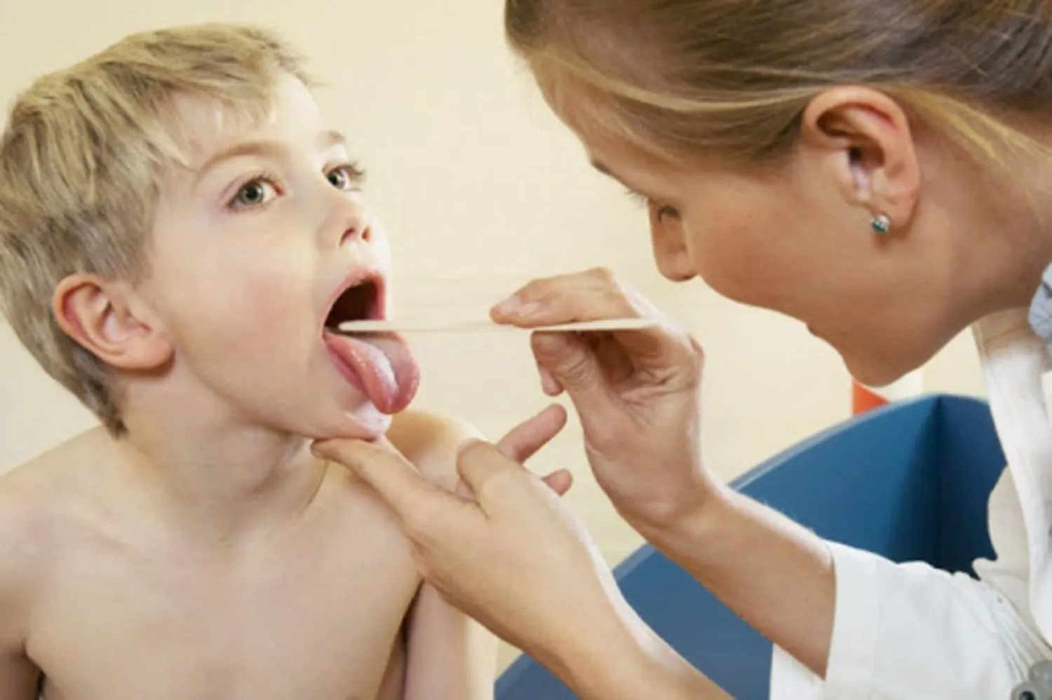 Tăng bạch cầu đơn nhân ở trẻ (Mononucleosis – bệnh do những nụ hôn)