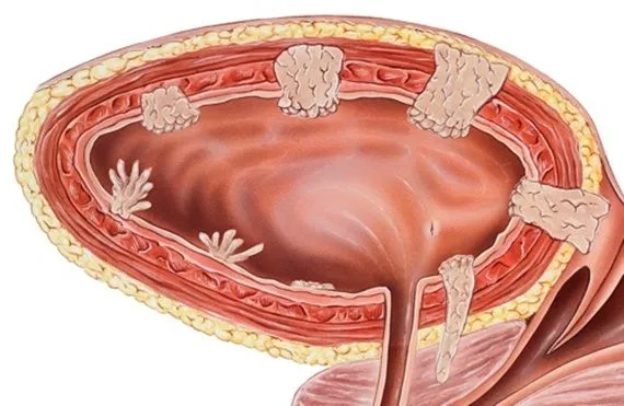 Triệu chứng và điều trị ung thư bàng quang giai đoạn cuối