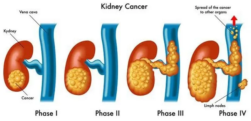 Các giai đoạn ung thư thận