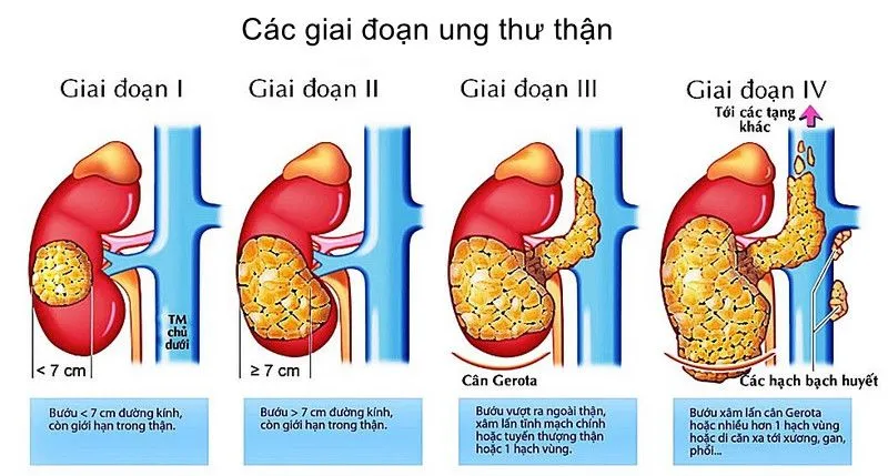 Các giai đoạn ung thư thận tế bào sáng