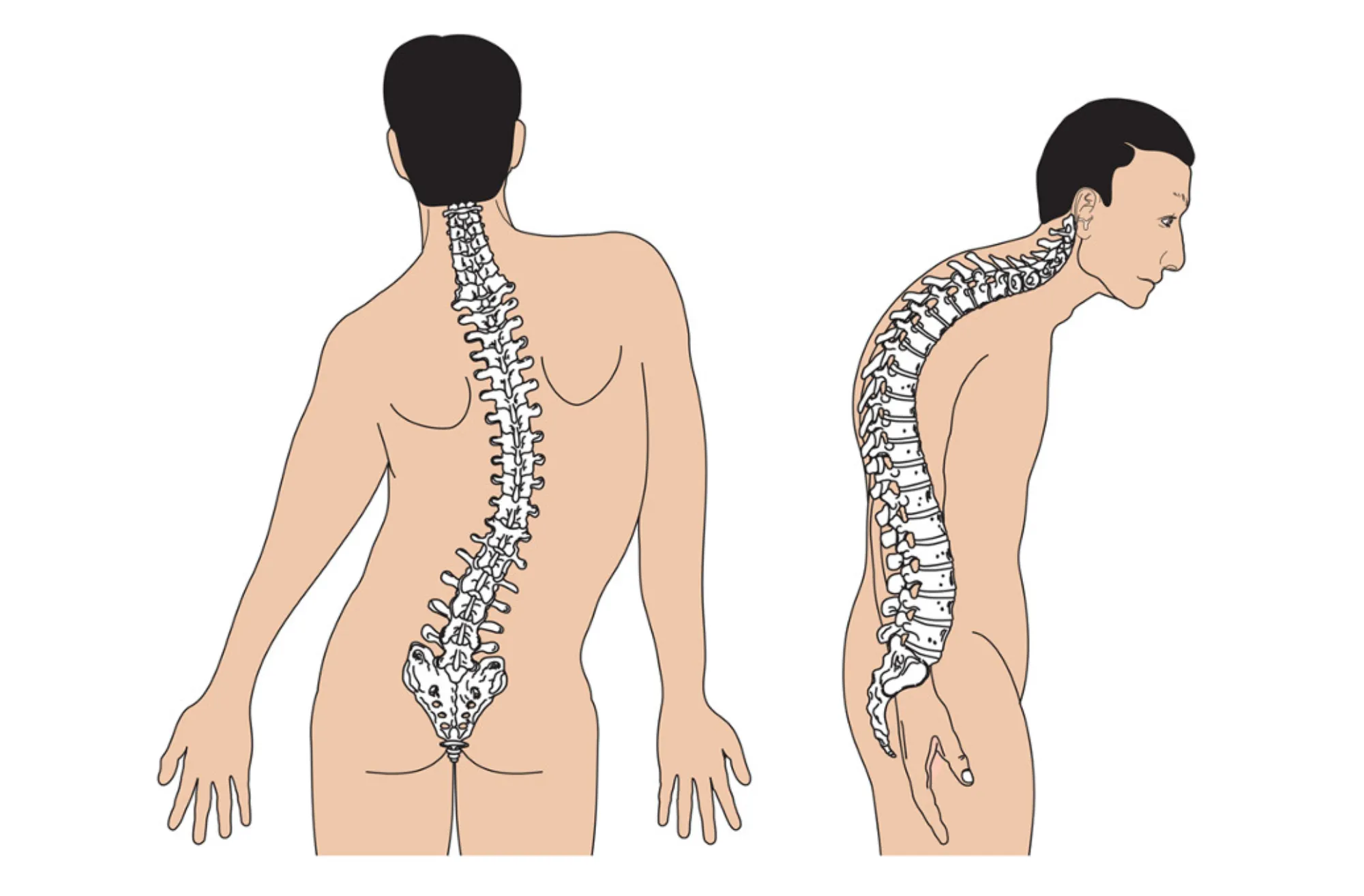 Vẹo cột sống có phải phẫu thuật không?