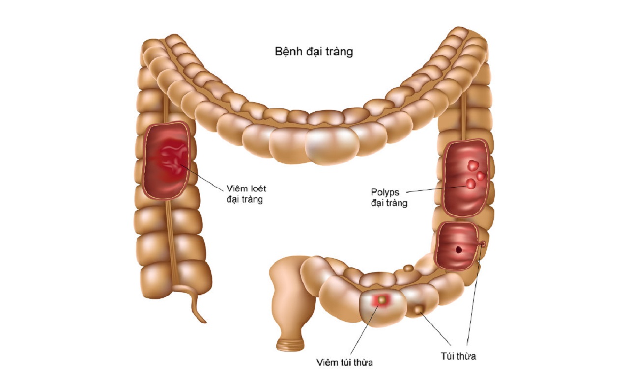 10 dấu hiệu viêm đại tràng mãn tính phổ biến