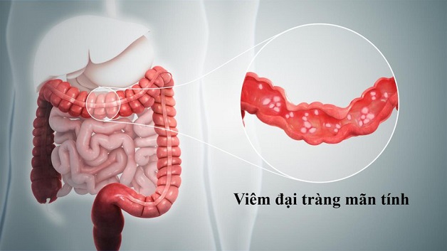 10 dấu hiệu viêm đại tràng mãn tính phổ biến