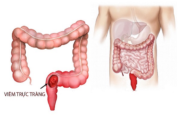 10+ Nguyên nhân gây đau trực tràng và cách giảm