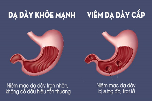 10 nguyên nhân gây viêm loét dạ dày thường gặp