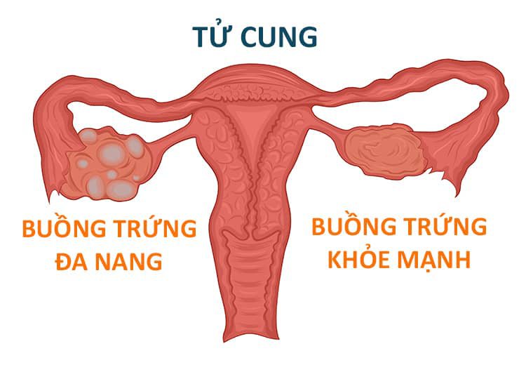 14 nguyên nhân gây kinh nguyệt không đều và cách khắc phục