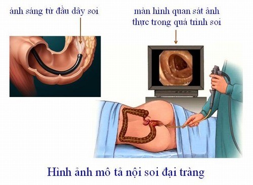 20% người trưởng thành mắc viêm đại tràng kích thích