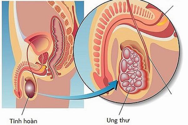 3 bệnh ung thư chỉ nam giới mới mắc