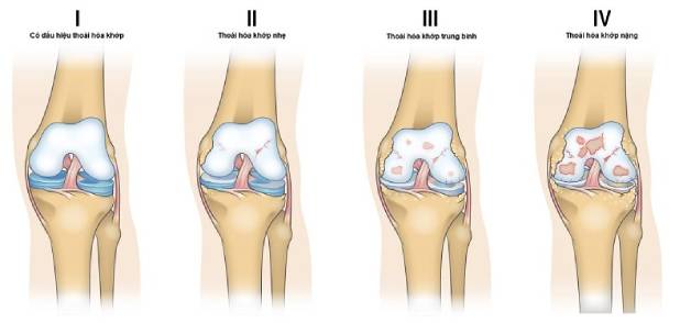 3 Bí quyết giúp bạn phòng thoái hóa khớp gối hiệu quả