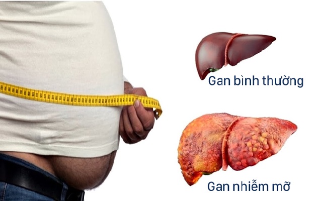 3 cách chữa bệnh gan nhiễm mỡ hiệu quả