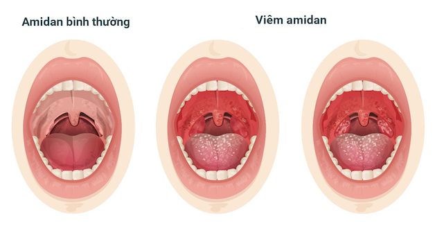 3 cách điều trị viêm amidan cấp hiệu quả