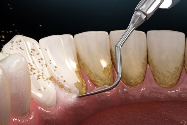 3 Cách loại bỏ cao răng tại nhà hiệu quả