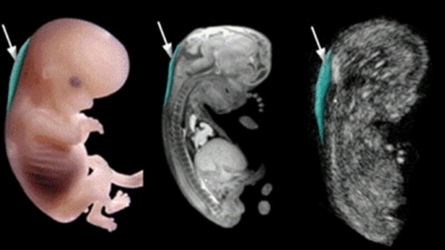 3 điểm khác biệt giữa Double Test và Triple Test