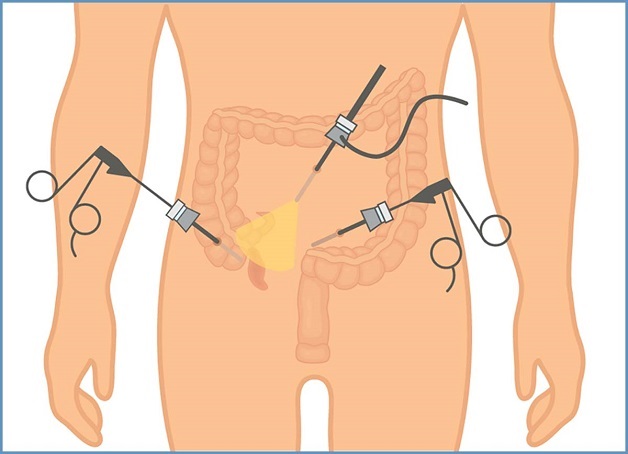 3 hiện tượng viêm ruột thừa điển hình