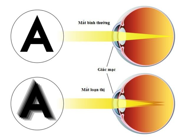 3 loại tật khúc xạ học đường phổ biến và cách phòng tránh