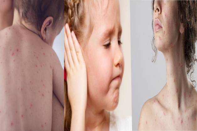 3 Lưu ý khi tiêm chủng vacxin phòng sởi – quai bị – rubella 