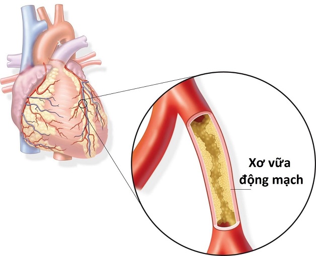 3 Phương pháp điều trị thiếu máu cơ tim cục bộ hiệu quả nhất