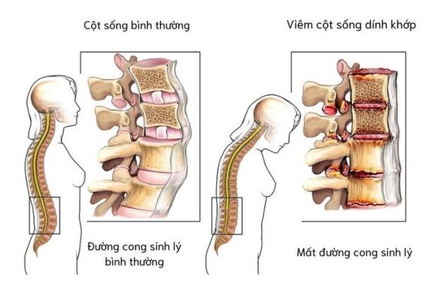 3 Phương pháp điều trị viêm cột sống dính khớp