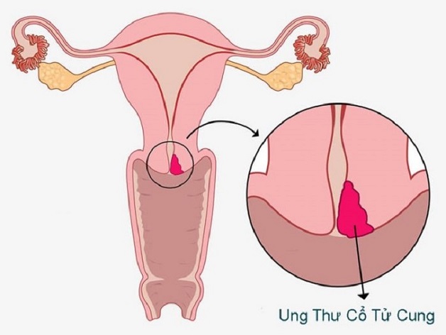 3 phương pháp sàng lọc ung thư cổ tử cung phổ biến hiện nay