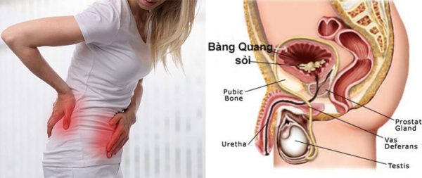 3 triệu chứng sỏi bàng quang thường gặp và cách điều trị hiệu quả