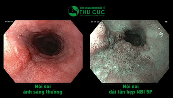 38 tuổi phát hiện ung thư thực quản dù không có triệu chứng