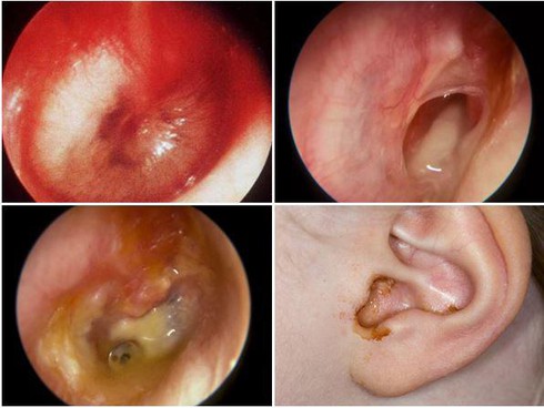 4 biến chứng nguy hiểm của bệnh cảm lạnh trẻ dễ mắc phải