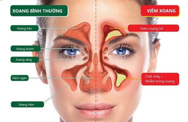 4 biến chứng nguy hiểm của bệnh cảm lạnh trẻ dễ mắc phải