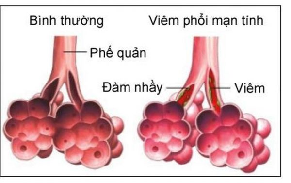 4 biến chứng nguy hiểm của bệnh cảm lạnh trẻ dễ mắc phải