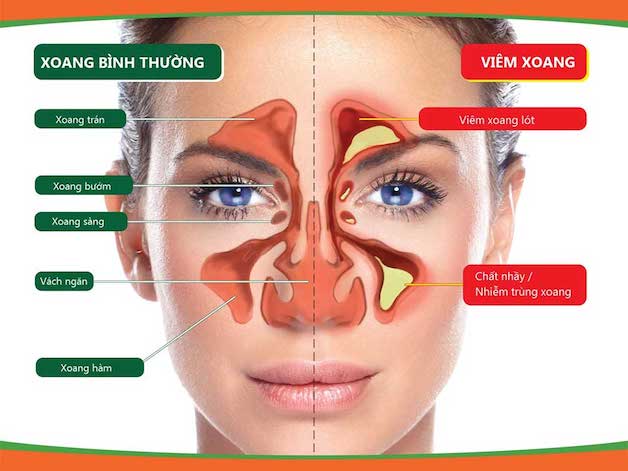 4 biến chứng viêm xoang và những hệ lụy